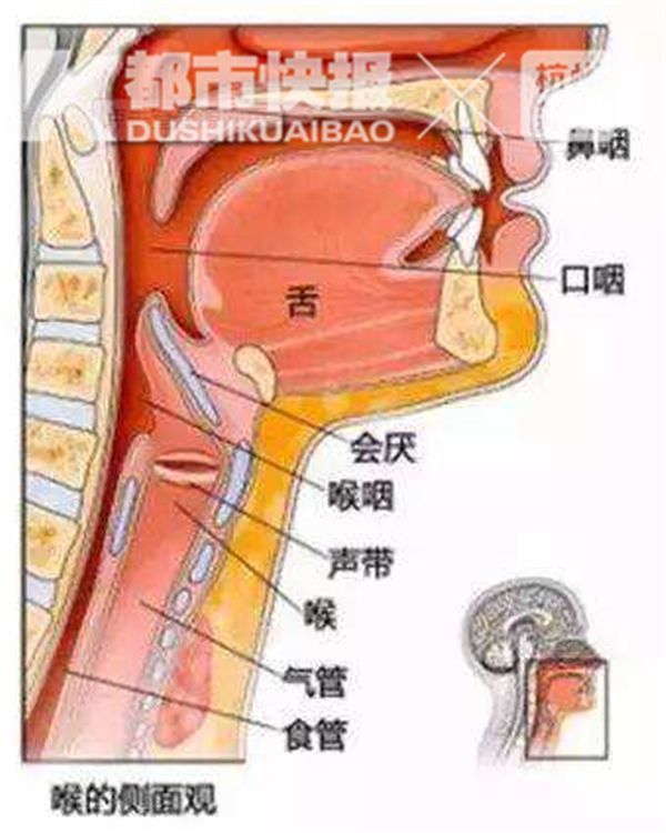 急性会厌炎是喉科的急重症之一,主要表现为会厌高度水肿,这是一种主要