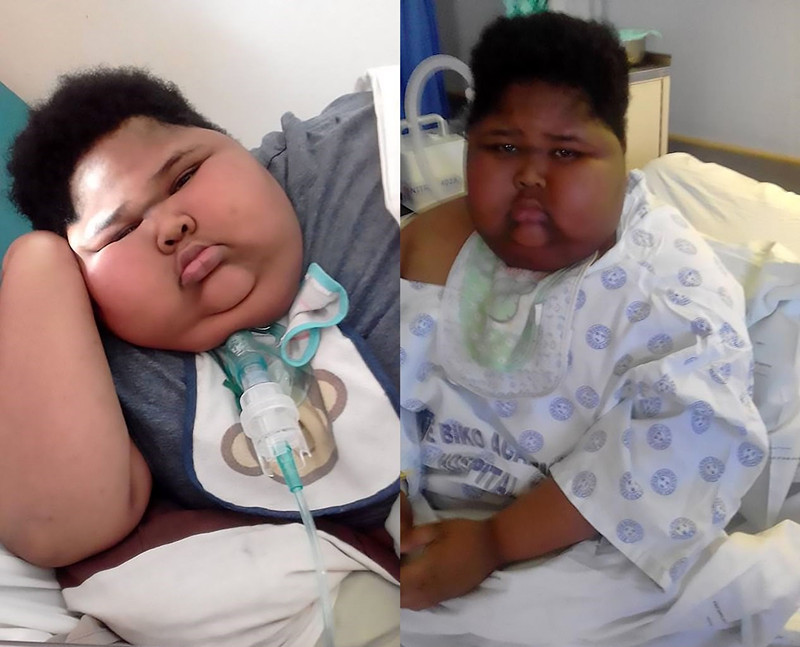 南非11岁小胖患病总感饥饿去世,重180斤曾因吃卫生纸上头条