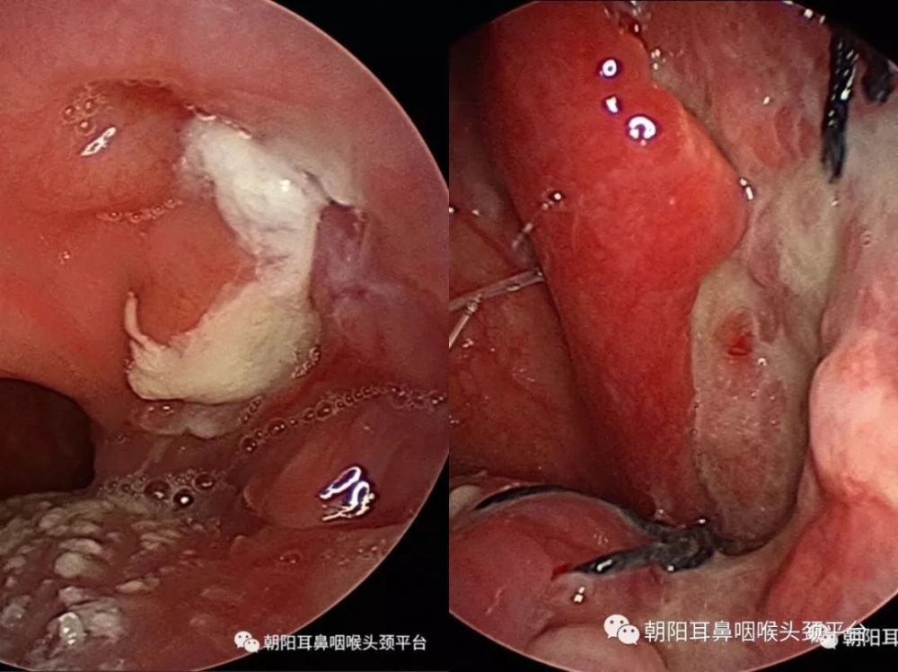 单侧扁桃体肿大 谨防是扁桃体癌