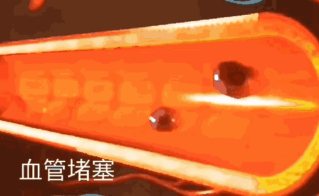 微针定位治疗血栓技术如何从血管中剥除血栓
