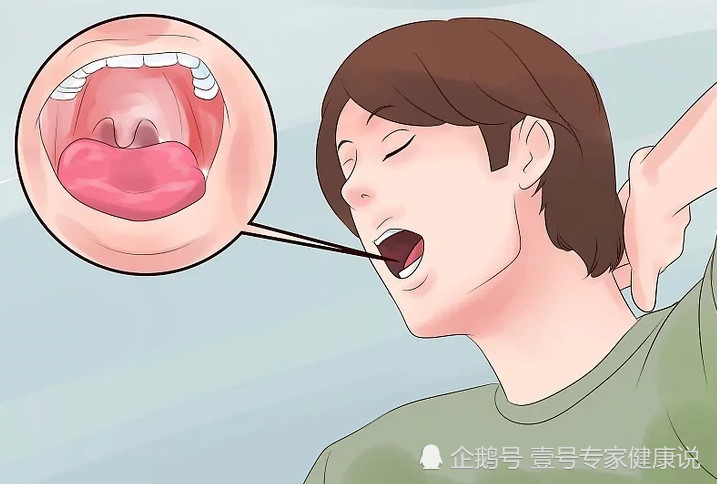 肺癌,喉癌,甲状腺癌,都有同一个症状:嘴里出现这种变化要小心