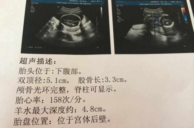 孕检时,b超单上的这3个"迹象,或许孕妈要迎接"小情人"了