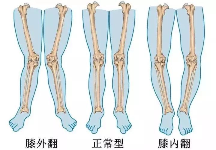 所以刚出生的婴儿十有八九其小腿都是内弯而且合并内旋的.