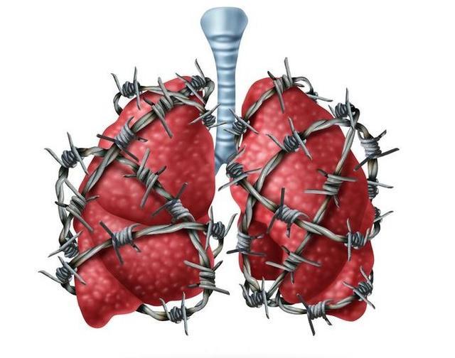 据调查,我国每年新发肺癌病例超过70万,而有近60万的人死于肺癌