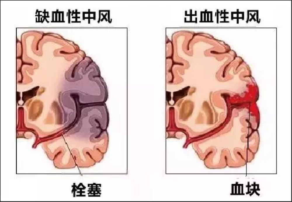 什么是脑中风和腔隙性脑梗,保险里的轻微脑中风,到底有多轻?