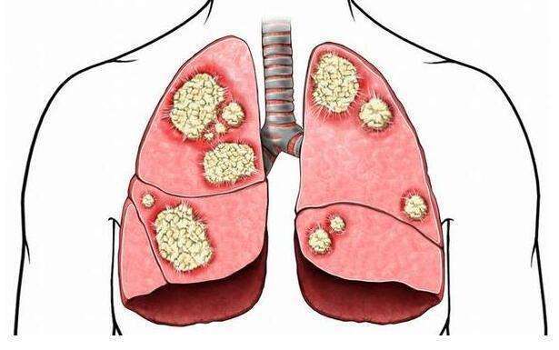 2,生长在 肺脏周边,靠近胸膜,在较早期会出现胸痛,凶猛等不适; 肺癌