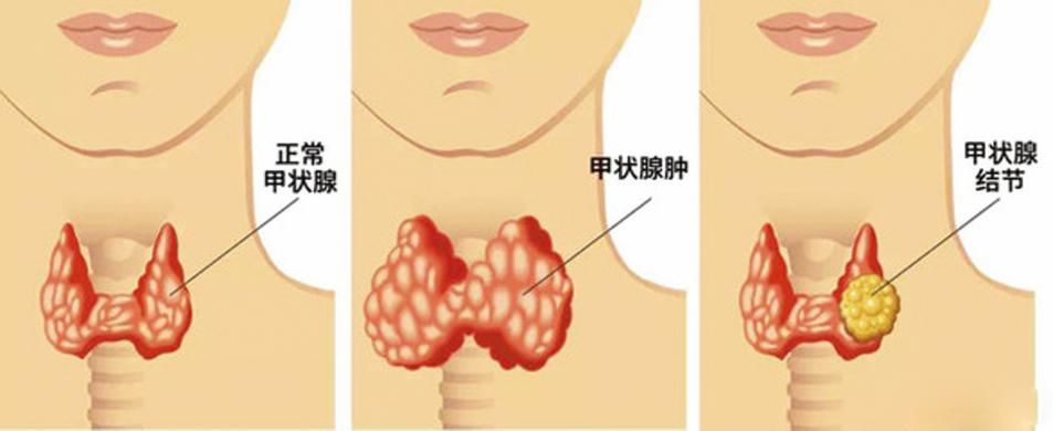 甲状腺结节,甲状腺功能,结节,颈部,马慧发,医师,甲状腺癌