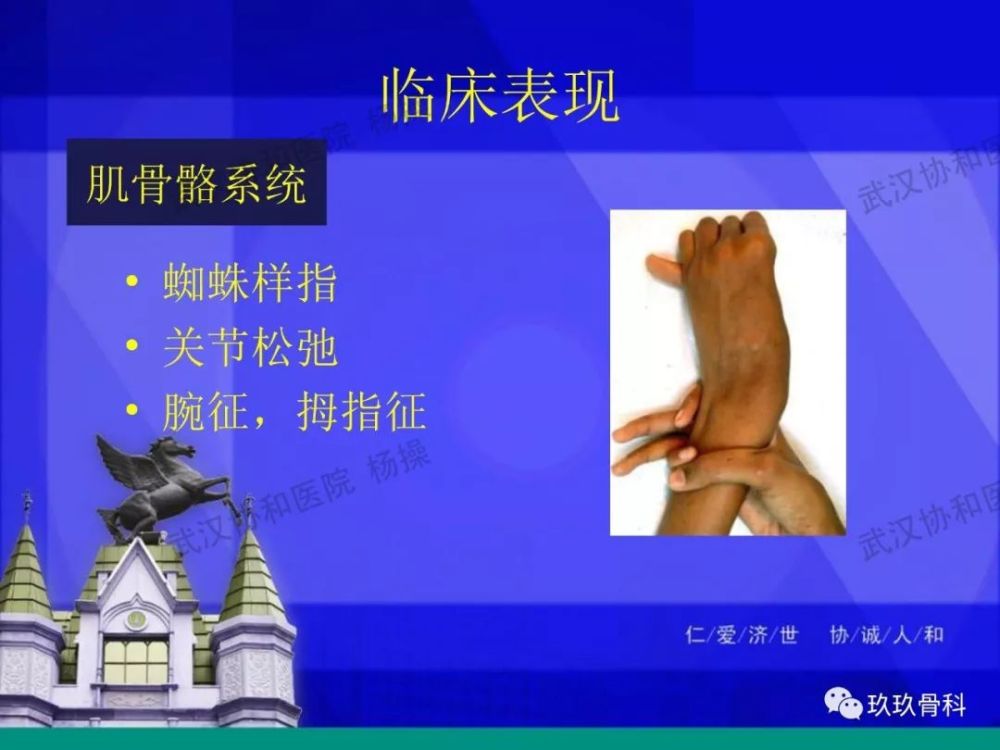 马凡综合征