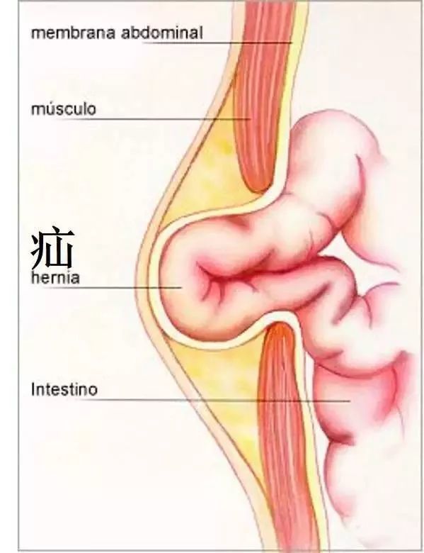 腹股沟斜疝,疝气,腹腔镜,腹壁