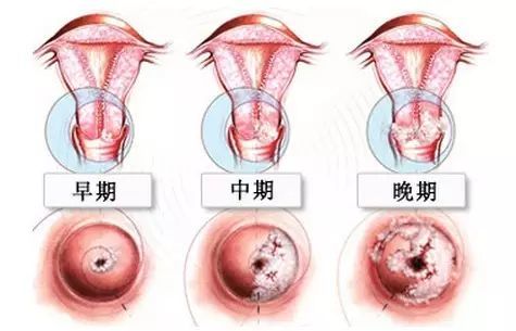 温 馨 提 醒 如果发现自己有脱肛的症状,及时到专业权威医院检查治疗