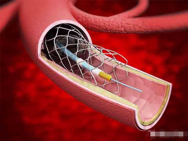 心脏支架的危害?真正目的被揭开,真相让人不敢相信!