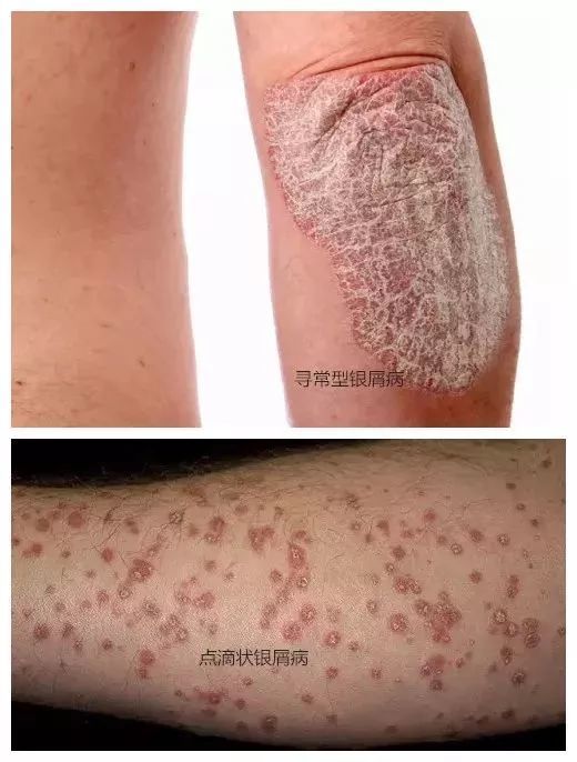 寻常型银屑病临床表现多种多样,十分复杂,按皮损形态分有点滴状,钱币