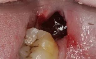 拔牙后干槽症如何形成的?怎么治疗?