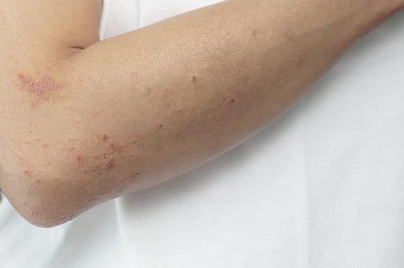 肛门处的 肉疙瘩 是痔疮 不一定 或许是2个 病症 看点快报