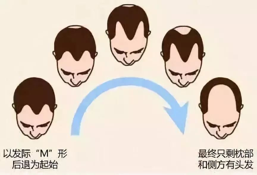 男性脱发过程示意图