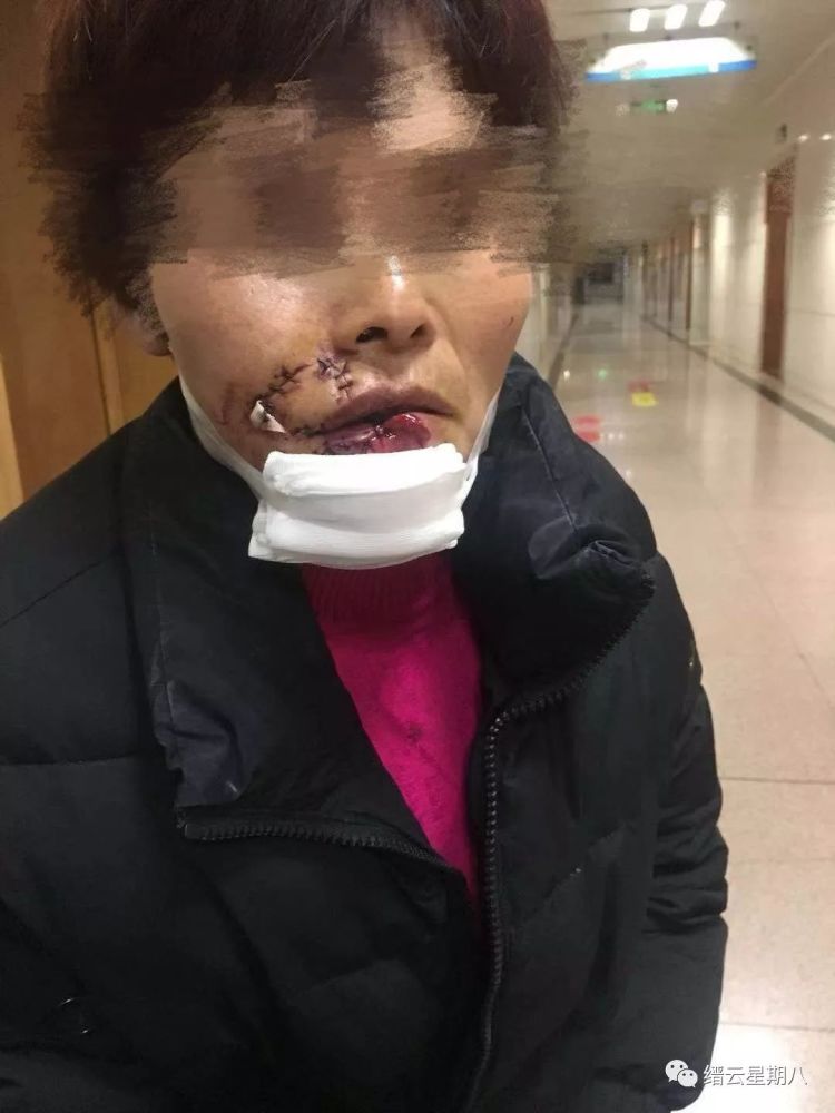 缙云53岁阿姨被自家狗咬伤脸,嘴唇少了一块肉!狗为何会发狂咬主人?