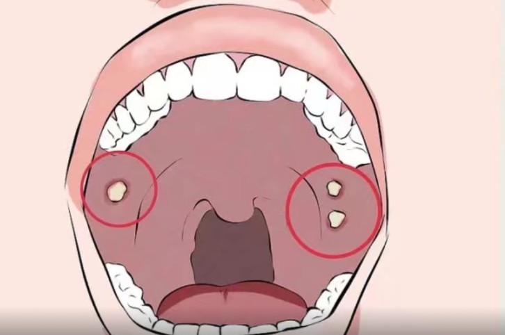 警惕!当发现嘴里出现这种斑,有可能是口腔癌在敲开你的嘴巴