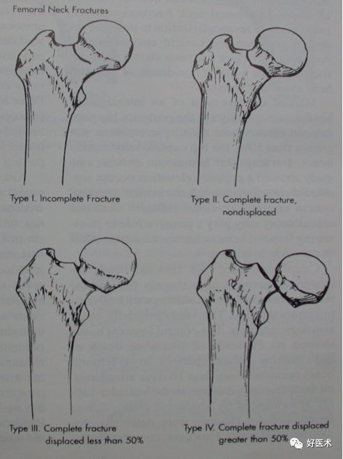 股骨颈骨折的手术原则,看完让你茅塞顿开!