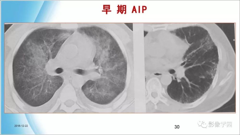 间质性肺炎的hrct诊断