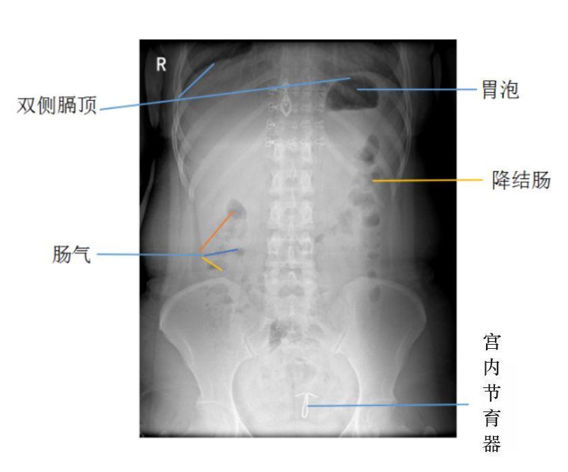 消化道穿孔影像学表现,原来要这样看!