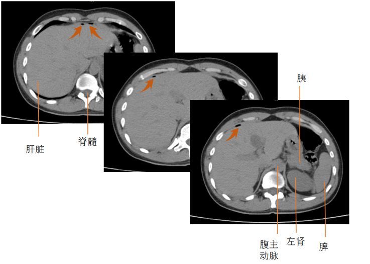 消化道穿孔影像学表现,原来要这样看!