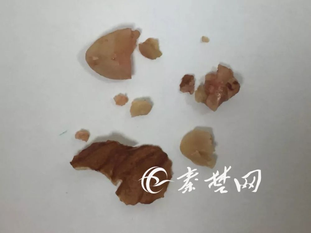 十堰1岁男童高烧咳嗽一个星期 口里取出了5个