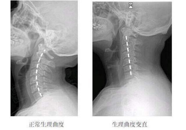 颈椎变直,曲度没了就会这样!医生教你恢复