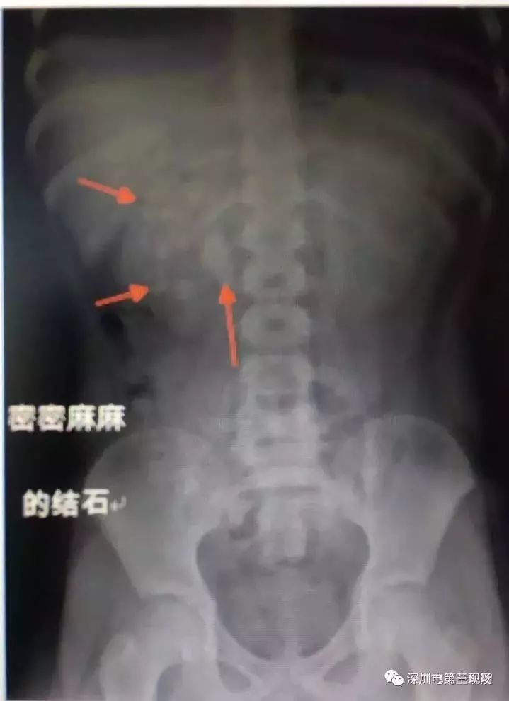 男孩小轩 腰部总是间歇性隐隐作痛, 但家里的老爸老妈根本不当一回事