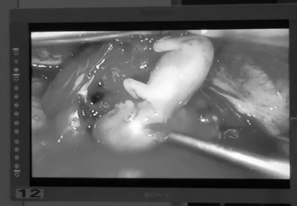 哈尔滨一女子怀孕三个月,胎儿胳膊腿都成型了,结果发现……医生都惊呆