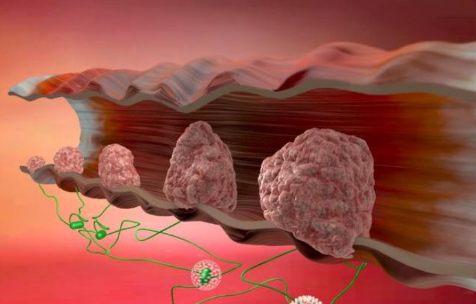 肠癌患者自述:查出便是晚期,这3个早期症状,被我彻底忽视了