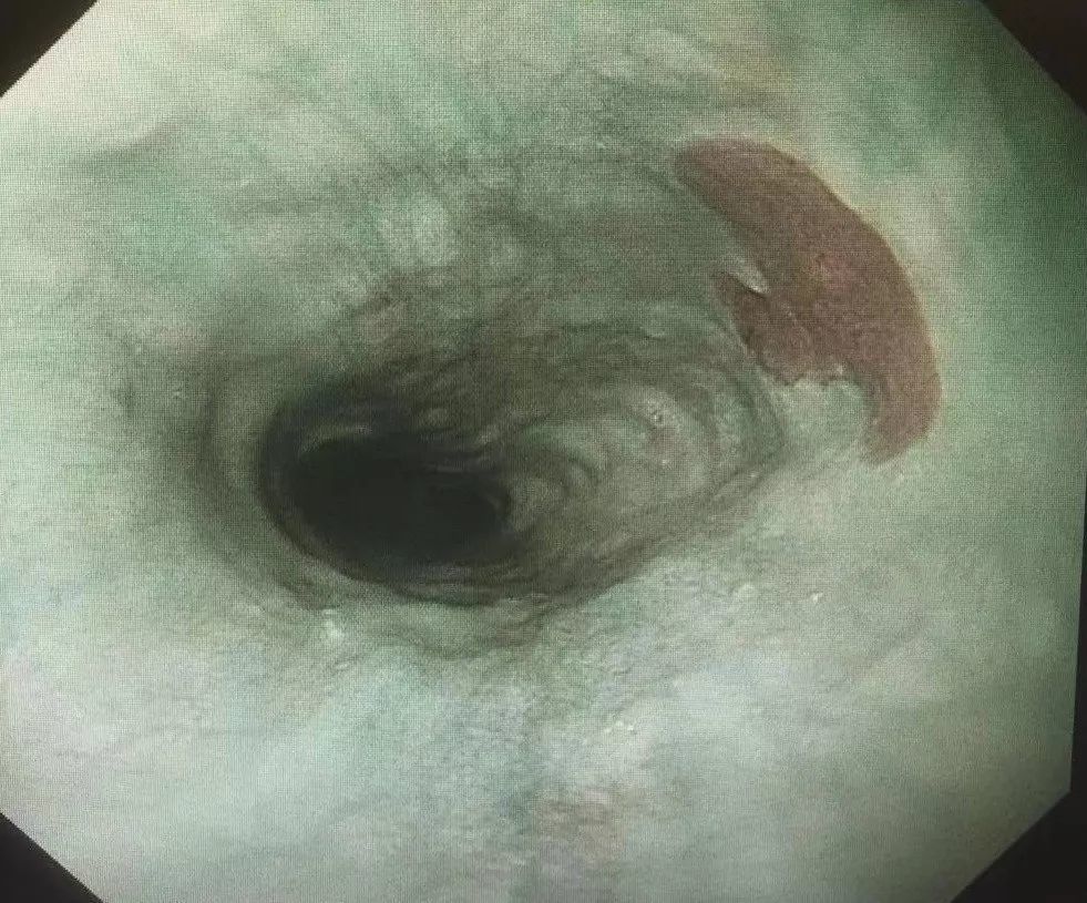 病例3 nbi 因异位胃黏膜位于食管上括约肌的下方,该段食管通常处于