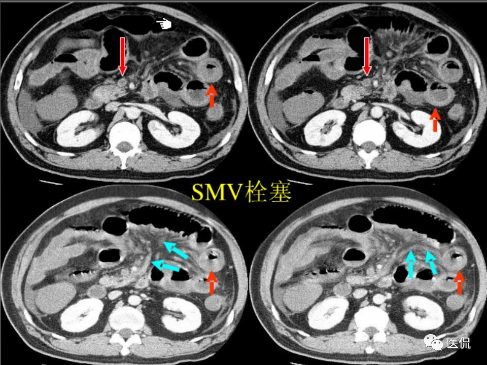 肠系膜血管病变的ct诊断#医学影像经典ppt