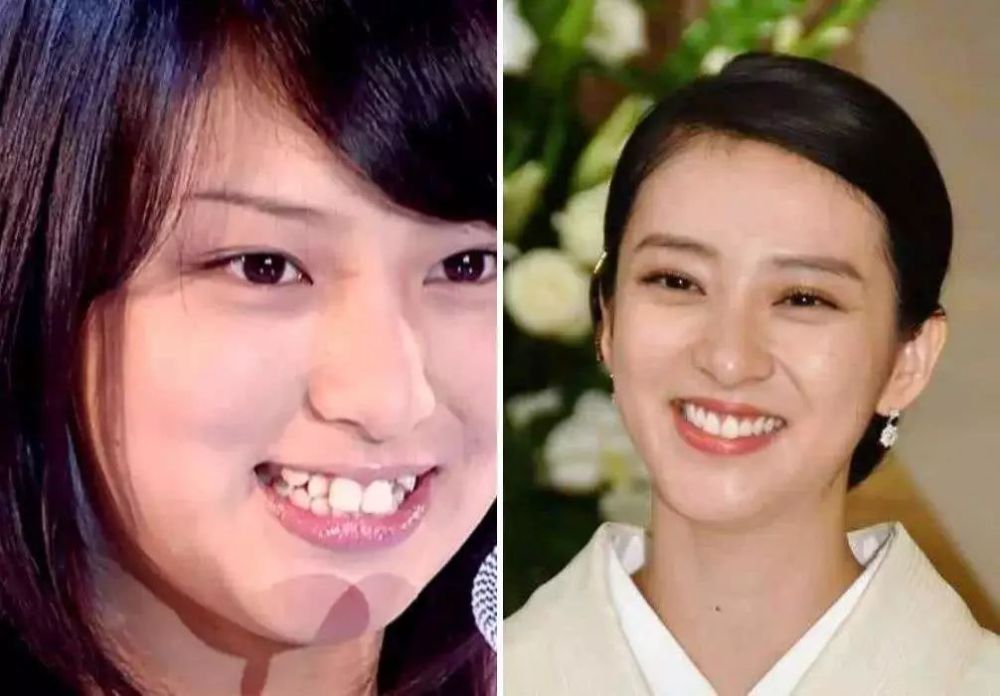 日本美少女的颜值为什么普遍败在牙齿难看?据说和吃东西有关!
