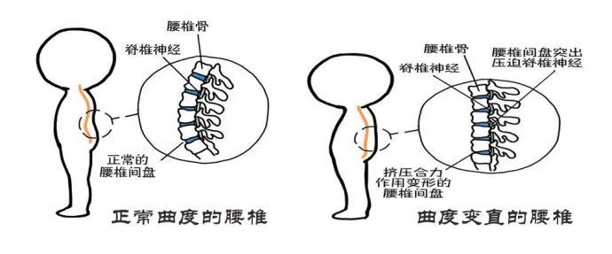 而背沟需要脊柱有一定曲度