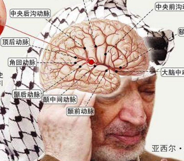 脑漏是什么病 腾讯网
