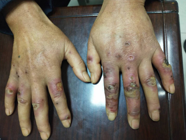长沙60岁男子长冻疮后仍用冷水洗菜 一个月后十根手指溃烂不堪