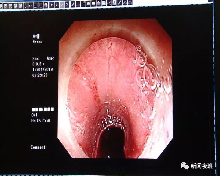 南宁友仔边喝粥边玩手机,被花甲螺壳卡喉咙,划破食道!