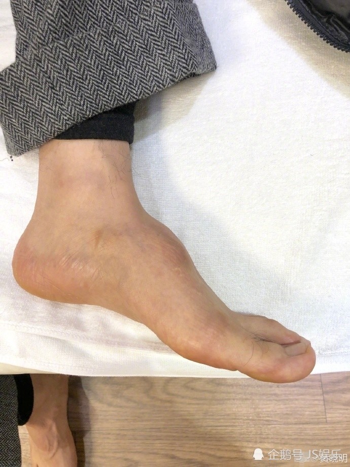 黄晓明晒受伤左脚回应"垫鞋垫",高高凸起的脚背引人心疼