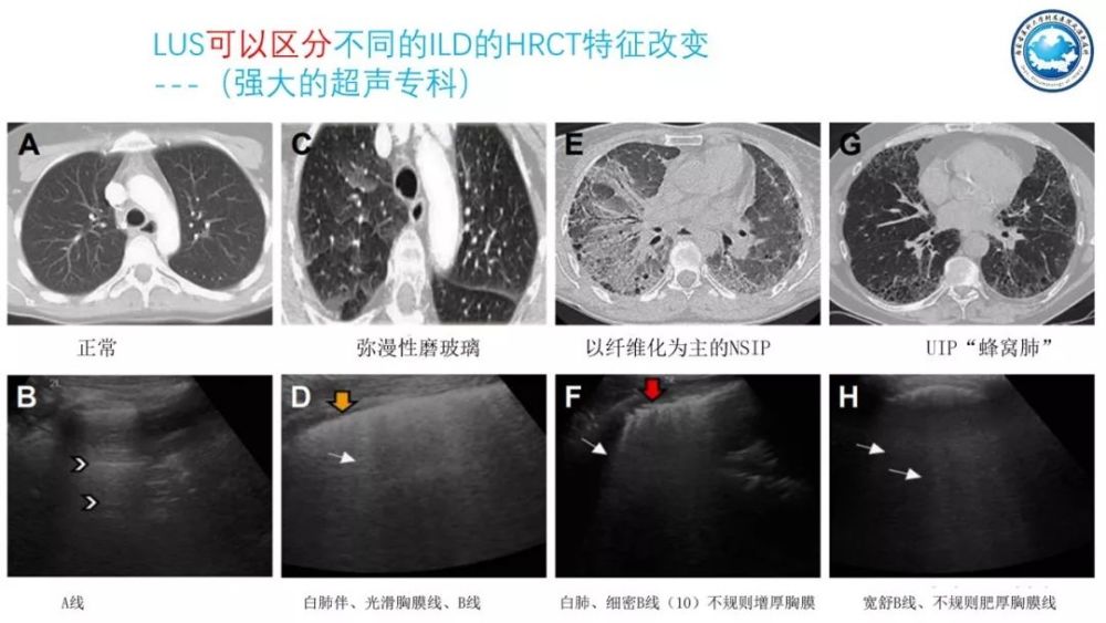 间质性肺病 腾讯网