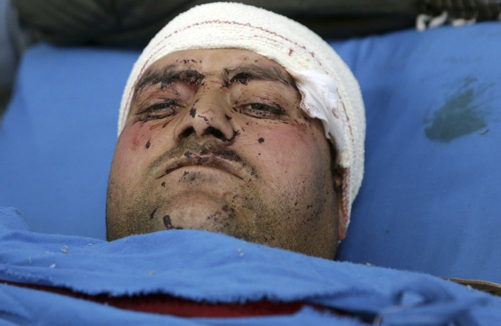 一名受伤人员脸部被爆炸碎片炸伤.