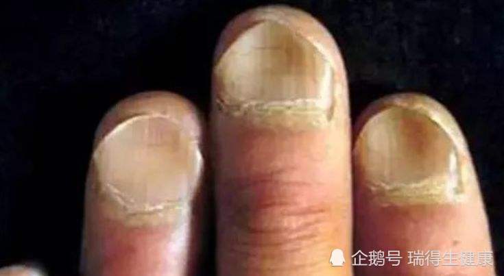 5 ,指甲变化 这种症状相对前面4种来说不常见,有些肝硬化患者会出现