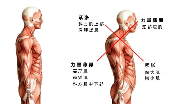 从人体侧面看很像一个"x",所以这种病症被称为"上交叉综合征"