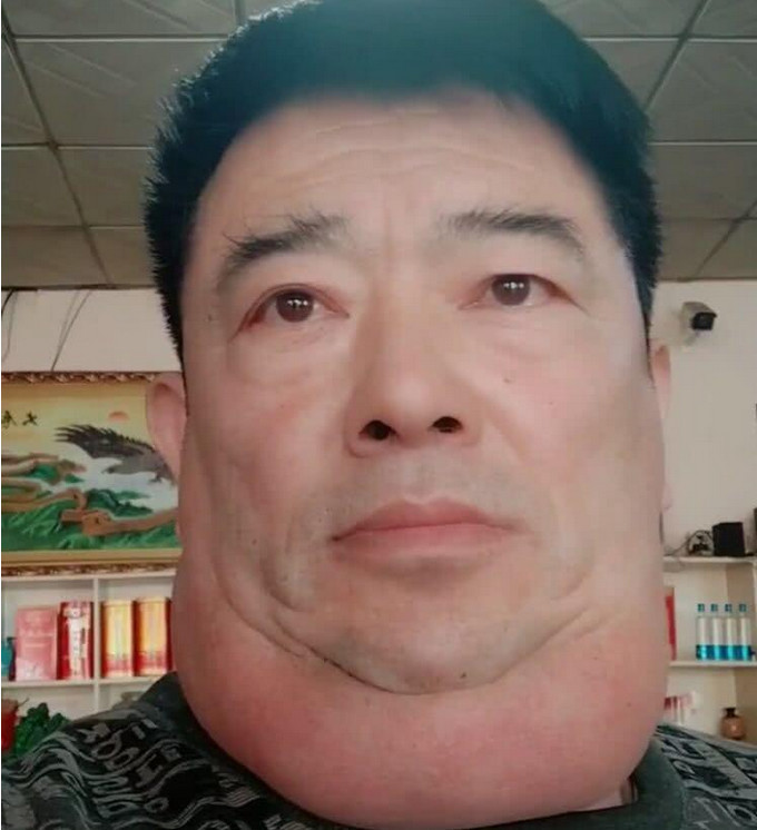 男子贪酒一年内喝酒千斤,变成"河马脖"长了近30个脂肪