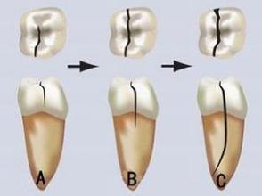 治疗牙髓炎为什么要抽神经 疼不疼-天天快报