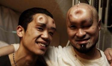 日本青年流行贝果头:往额头注盐水造肿块