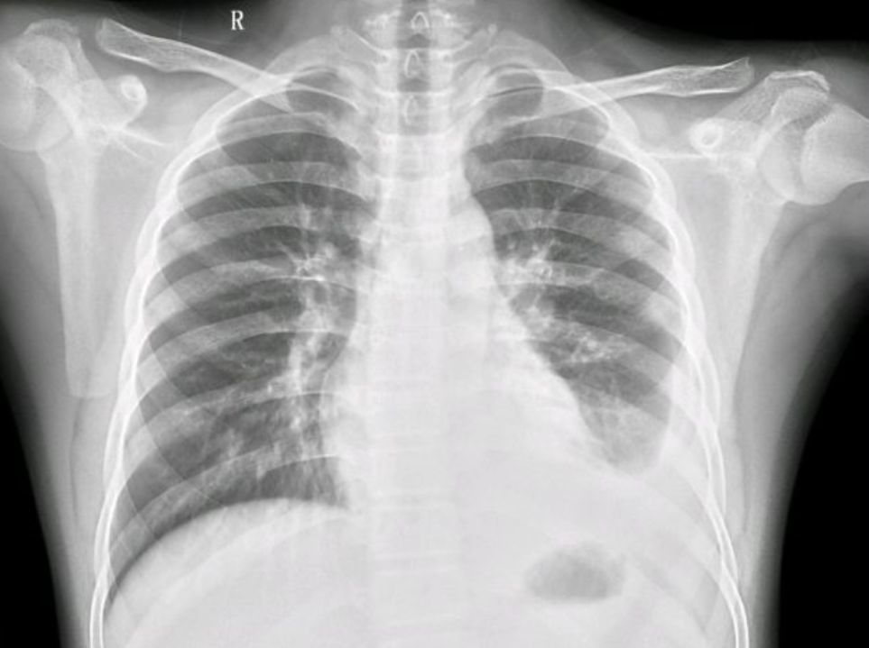 支原体肺炎引起的胸腔积液,这几个问题你掌握了没