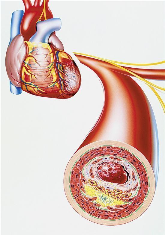 怎样才能把血管壁上的垃圾或斑块清除掉?医生告诉您答案!