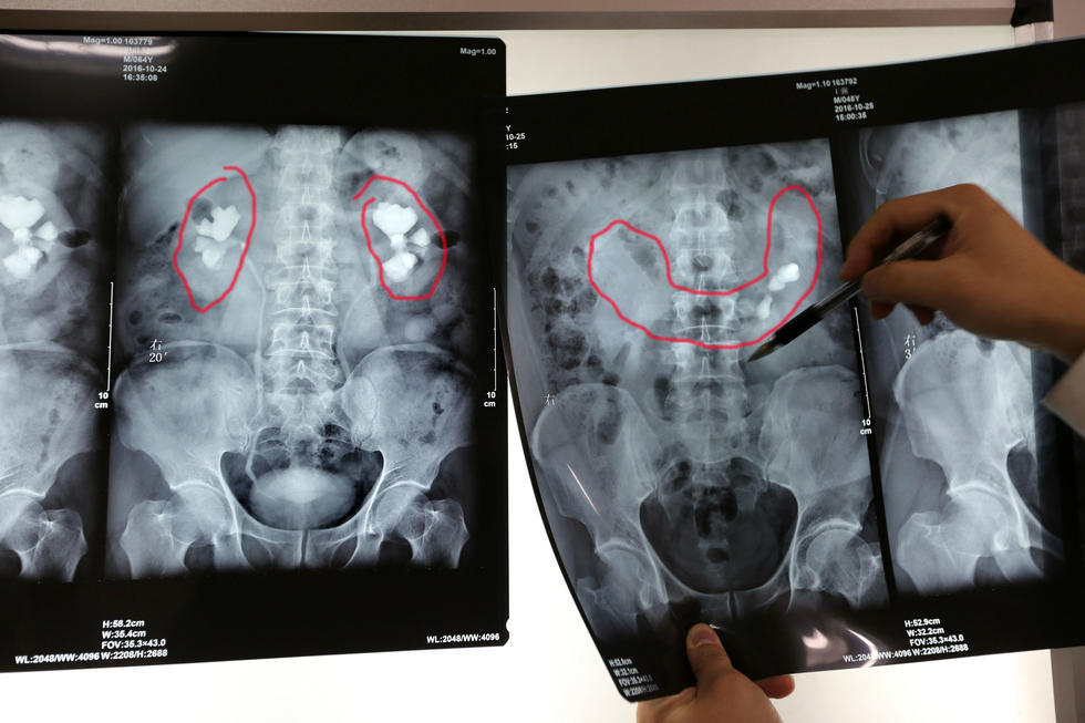 他双肾连成马蹄肾 结石碎了十多年