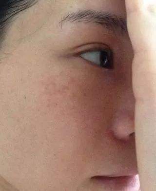 黄褐斑严重影响颜值 皮肤科主任 试试这4招 祛褐斑不显老 看点快报