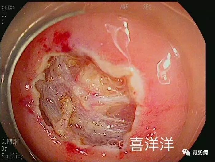 cd117  ,cd34   ,desmin-,sma ,ki-67约1%)支持低危险度胃肠道间质瘤